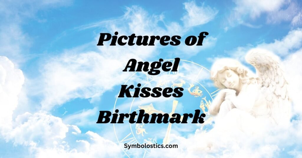Pictures of Angel Kisses Birthmark